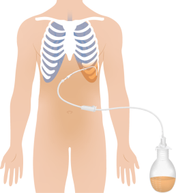 Illustration Pleuraerguss mit Vakuumflasche